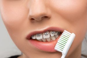 Care sunt regulile de buna… purtare a unui aparat dentar?